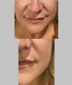 Aesthetic-lounge-filler ba i