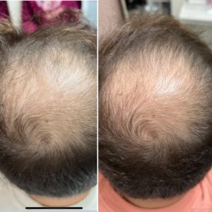 aestheticlounge-hairrestoration2